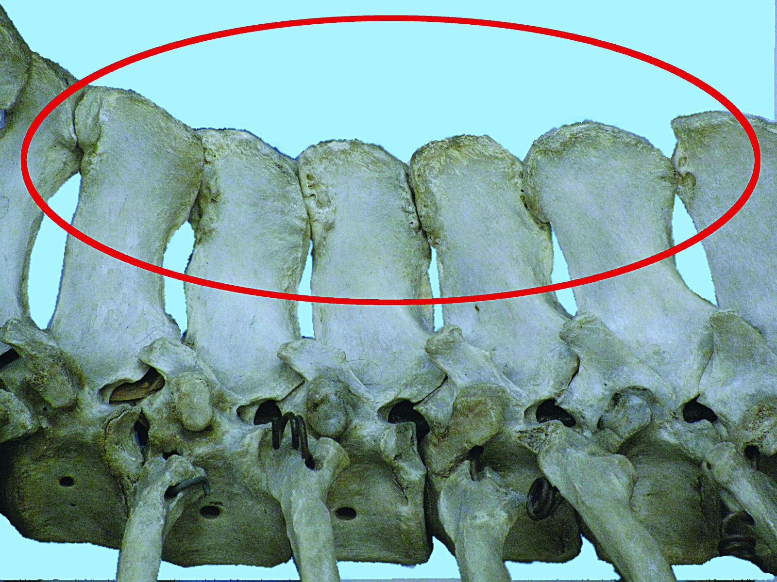 Хруст из-за сближения позвонков Хруст из-за сближения позвонков
