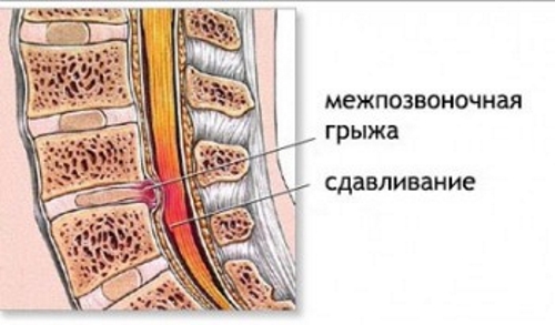 Воспалительный процесс из-за сдавливания нерва Воспалительный процесс из-за сдавливания нерва