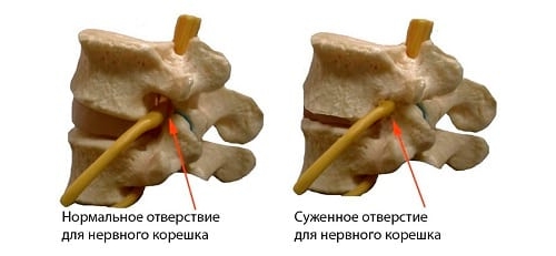 Сдавливание нервного корешка Сдавливание нервного корешка