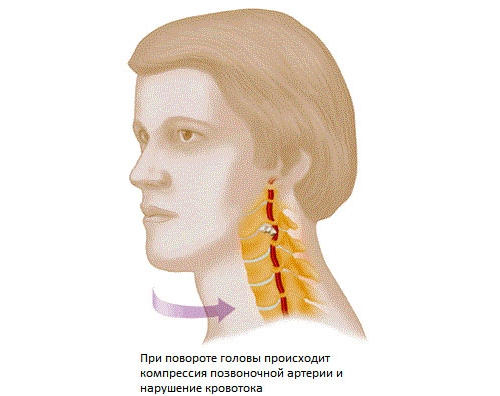 Сдавливание позвоночной артерии Сдавливание позвоночной артерии