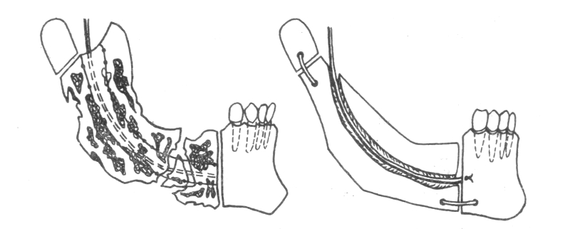 Секвестрэктомия Секвестрэктомия