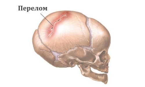 Схема перелома черепа у ребенка Схема перелома черепа у ребенка