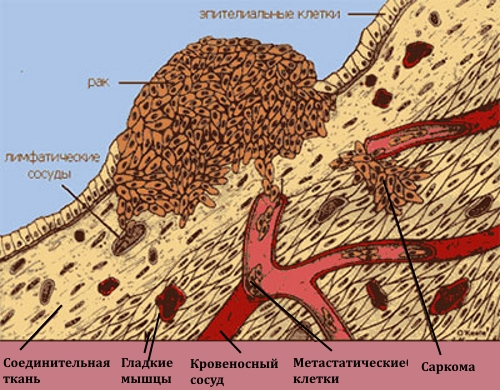 Схема саркомы кости Схема саркомы кости