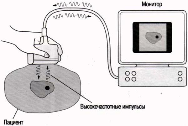 Схема действия ультразвуковой терапии Схема действия ультразвуковой терапии