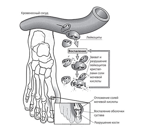 Схема возникновения подагрического артрита Схема возникновения подагрического артрита