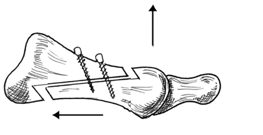 Шевронная остеотомия Шевронная остеотомия