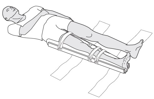 Наложение шины Наложение шины