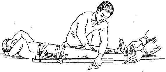 Шина при сильном разрыве связки колена Шина при сильном разрыве связки колена