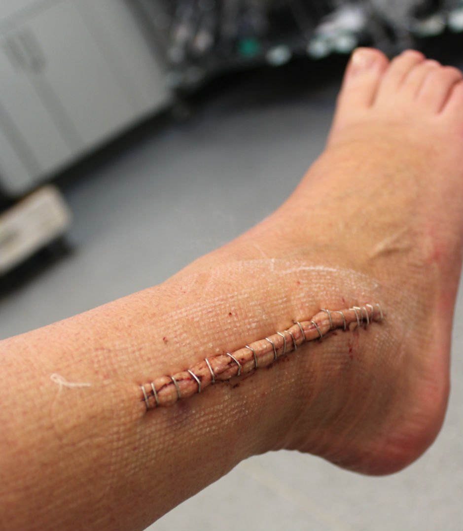 Шов после операции на лодыжке