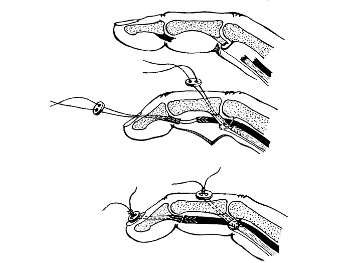 Сшивание сухожилия разгибателя Сшивание сухожилия разгибателя