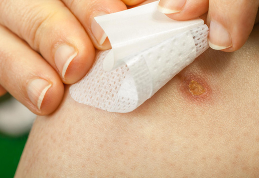 след после ожога