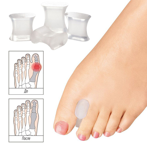 Межпальцевые силиконовые перегородки при косточке на ноге Межпальцевые силиконовые перегородки при косточке на ноге