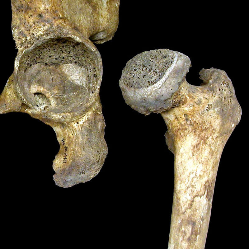 Сильное поражение коксартрозом Сильное поражение коксартрозом