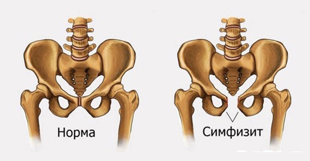 Симфизит Симфизит