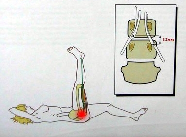 Симптом Легаса Симптом Легаса