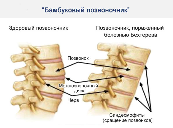 Симптом бамбуковой палки Симптом бамбуковой палки