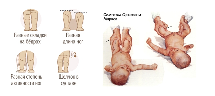Симптомы дисплазии тазобедренного сустава у ребенка Симптомы дисплазии тазобедренного сустава у ребенка
