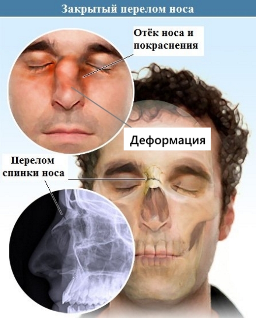 Симптомы закрытого перелома носа Симптомы закрытого перелома носа