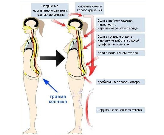Симптомы повреждения копчика Симптомы повреждения копчика