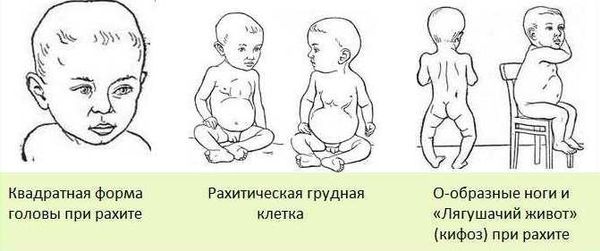 Признаки рахита у детей Признаки рахита у детей