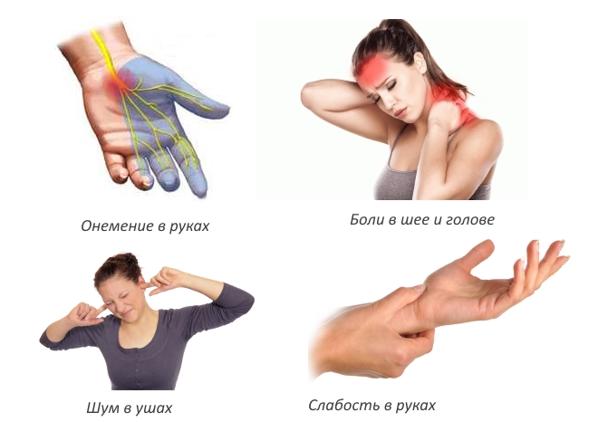 Симптомы шейной грыжи Симптомы шейной грыжи