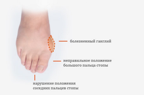Симптомы вальгусной деформации стопы Симптомы вальгусной деформации стопы