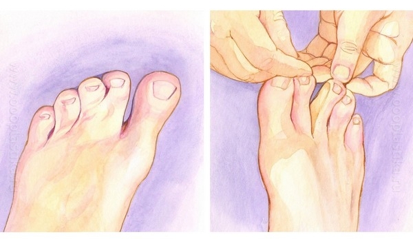 Синдактилия пальцев ног Синдактилия пальцев ног