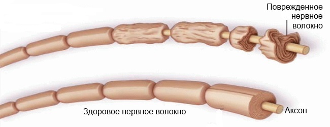 Синдром Гийена-Барре Синдром Гийена-Барре