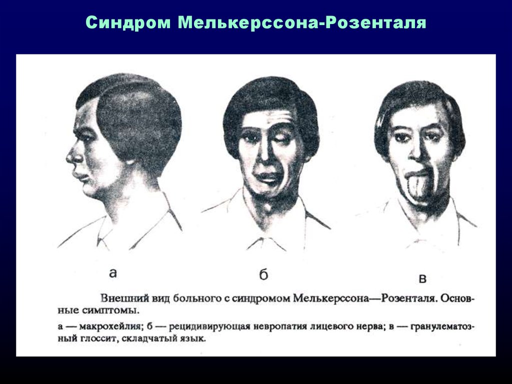 Синдром Мелькерсона-Розенталя Синдром Мелькерсона-Розенталя