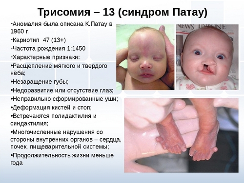 Синдром Патау Синдром Патау