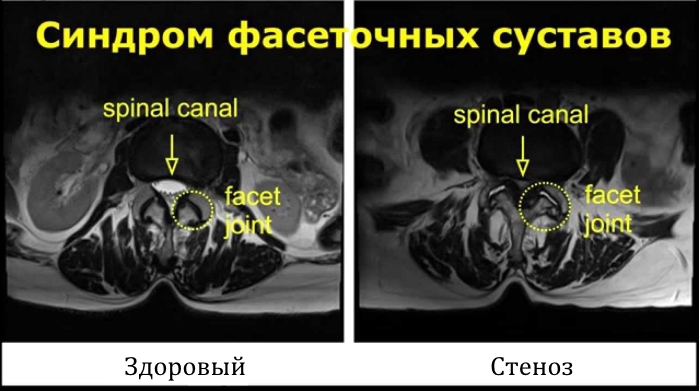 Синдром фасеточных суставов на МРТ Синдром фасеточных суставов на МРТ
