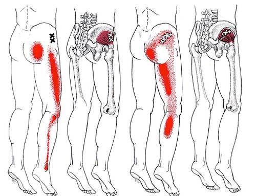 Распространение боли при синдроме грушевидной мышцы Распространение боли при синдроме грушевидной мышцы