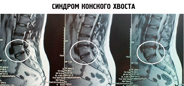 Сдавление нервных корешков конского хвоста на МРТ Сдавление нервных корешков конского хвоста на МРТ