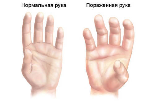 Синдром Зудека Синдром Зудека