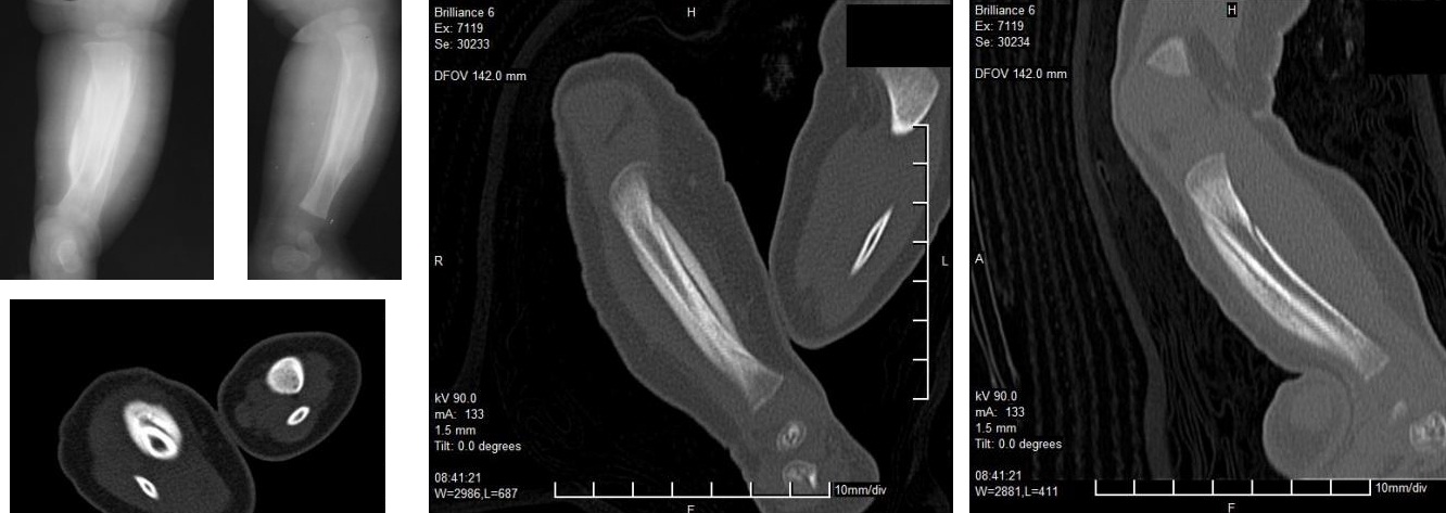 Синдром Каффи-Силвермена Синдром Каффи-Силвермена