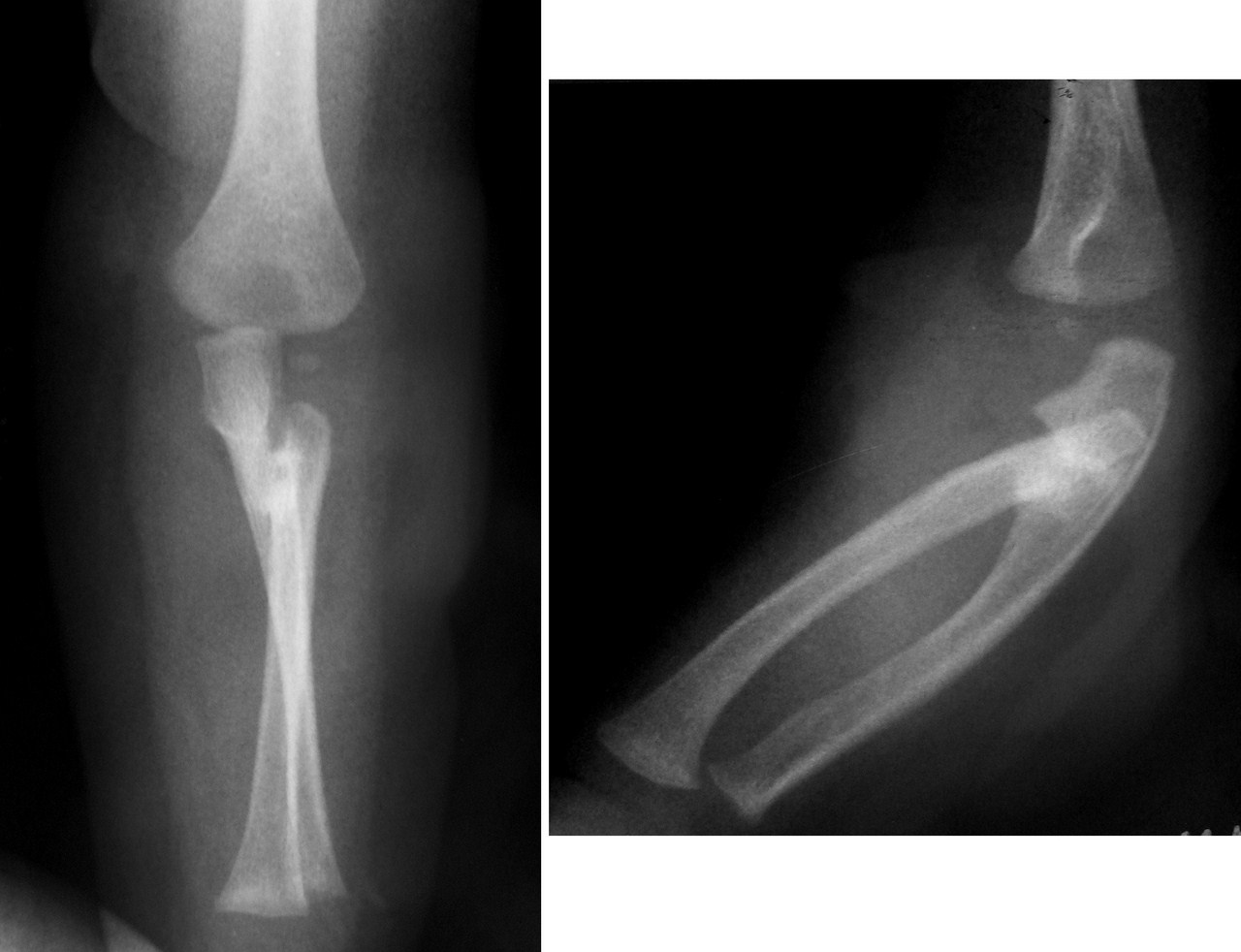 Рентген снимок синостоза Рентген снимок синостоза