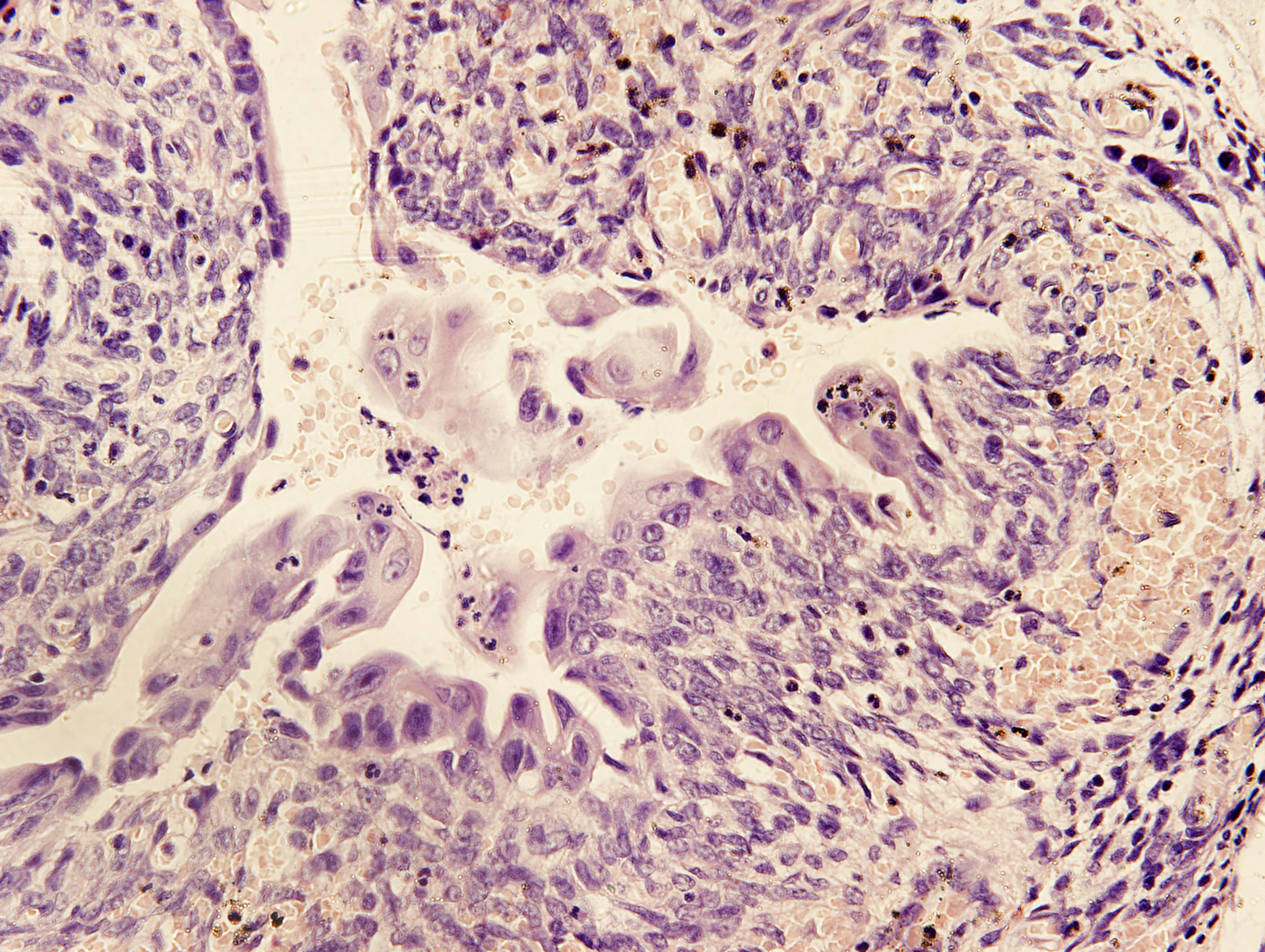 Микроскопия синовиальной синовиомы Микроскопия синовиальной синовиомы