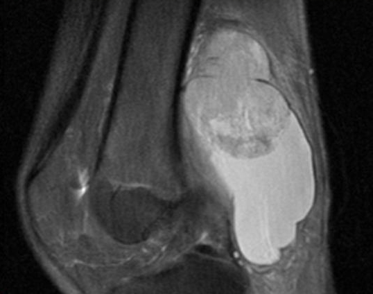 Синовиальная саркома на МРТ Синовиальная саркома на МРТ