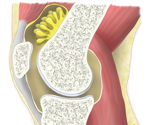 Синовиальный ходроматоз Синовиальный ходроматоз