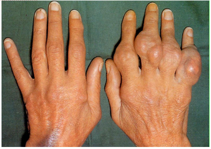 Синовиома кистей рук Синовиома кистей рук