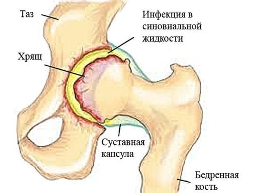 Синовит тазобедренного сустава Синовит тазобедренного сустава