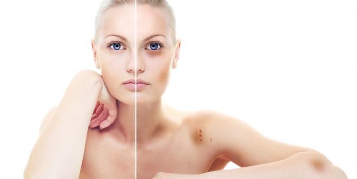 Лечение синяков на теле и лице