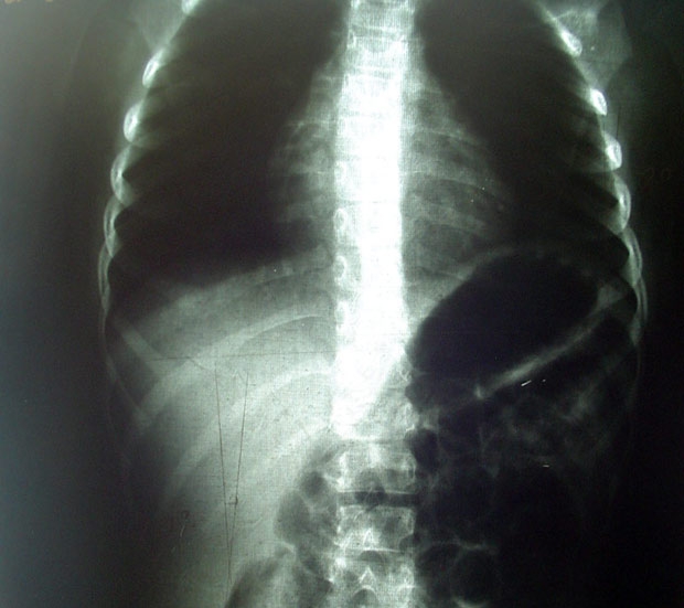 Сколиоз 1 степени на рентген снимке Сколиоз 1 степени на рентген снимке
