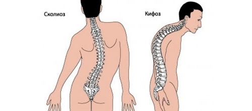 Сколиоз и кифоз Сколиоз и кифоз