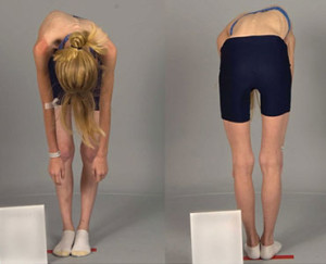 Сколиоз и неравномерная длина ног Сколиоз и неравномерная длина ног