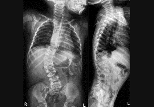 Сколиоз на рентген снимке Сколиоз на рентген снимке