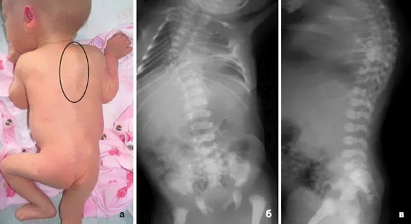 Врожденная патология позвоночника Врожденная патология позвоночника
