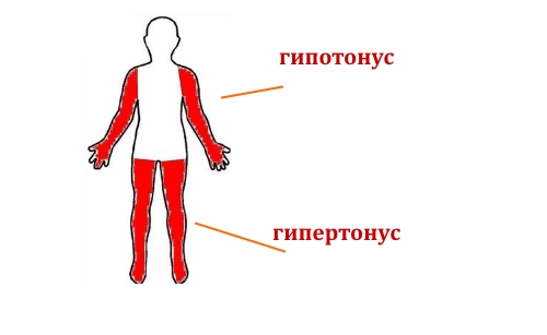 Смешанный тетрапарез Смешанный тетрапарез