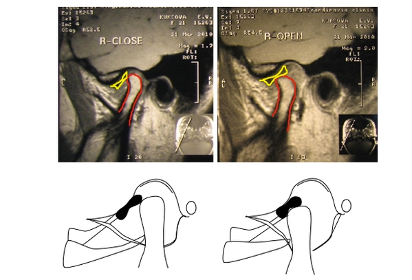 Смещение суставного диска ВНЧС на МРТ Смещение суставного диска ВНЧС на МРТ
