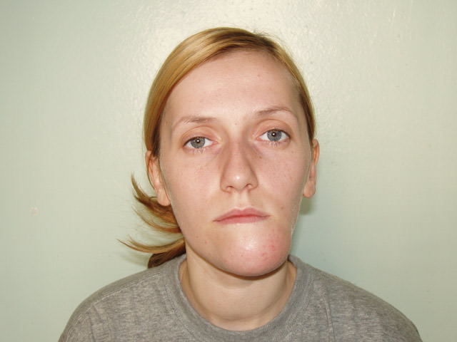 Смещение челюсти после перелома